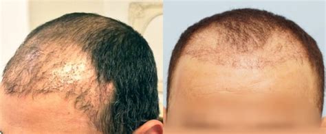 Hair Transplant Gone Wrong An Experts Advice On What To Do Next