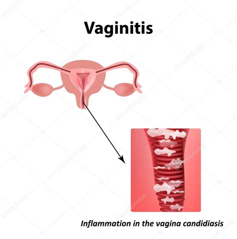 Vaginitis Inflamación En La Candidiasis Vaginal Aftas La Estructura