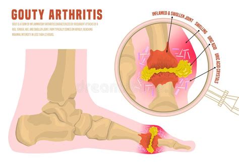 Artritis Gotosa InfogrÃfica Ilustración del Vector Ilustración de osteoartritis muestra