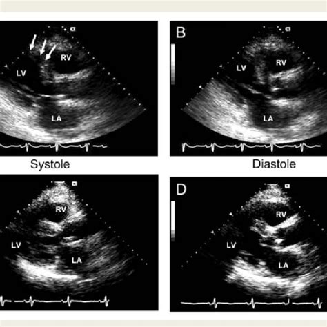 Parasternal Long Axis Echocardiography Views In Systole And Diastole