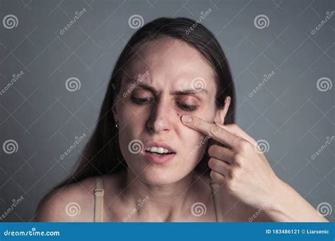 Portrait Of Female Popping Pimple Stock Image Image Of Prevention