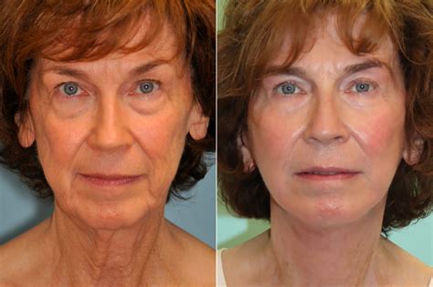 Blepharoplasty Photos Chevy Chase Md Patient 22611