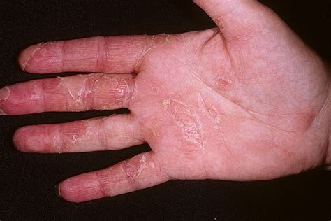 Dry Eczema On Hands Pictures 475 Photos And Images