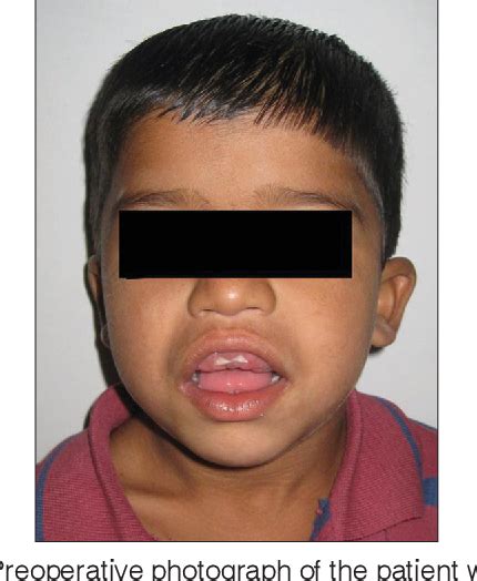 Figure From Non Syndromic Gingival Fibromatosis In A Mild Mental