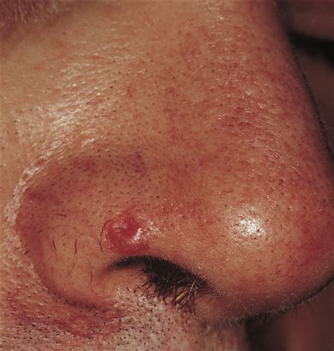 Dome Shaped Lesion On The Nose—quiz Case Dermatology Jama