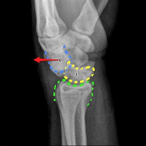 Lunate And Perilunate Dislocation Sinaiem