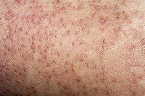 Little Bumps On Your Thighs Heres How To Deal With Keratosis Pilaris