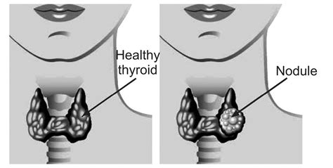 Thyroid Cancer Symptoms Treatment And Types Thyroid Nodules