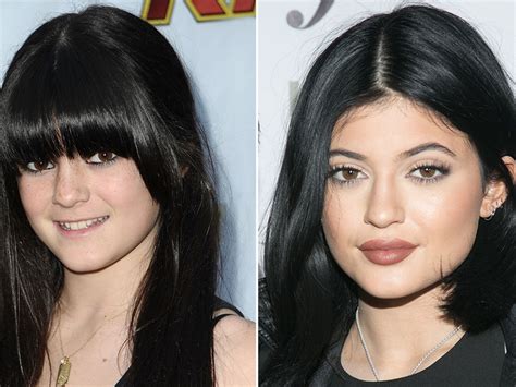 Kylie Jenners Lips And Nose Job Before And After Surgery Celebily
