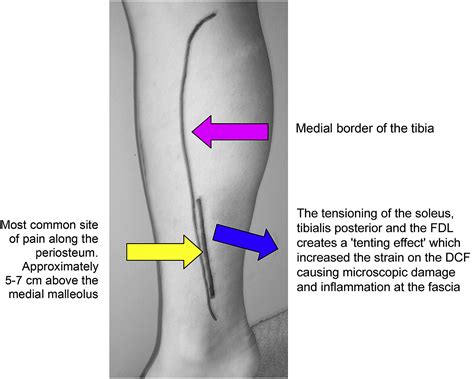 Massage Treatment And Medial Tibial Stress Syndrome A Commentary To
