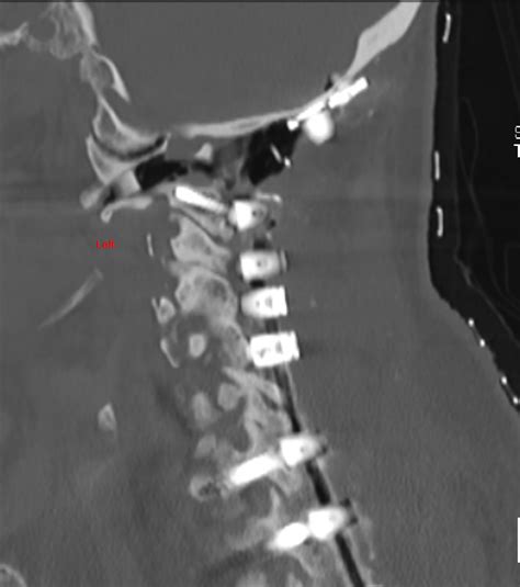 Occipito Cervical Fusion For Atlanto Axial Instability And