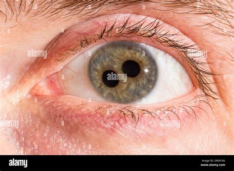 Macro Of A Mans Human Eye With Double Iris Close Up On The Two Pupils