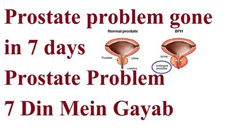 Prostate Problem Gone In Days Prostate Problem Din Mein Gayab Prostate Prostate Health