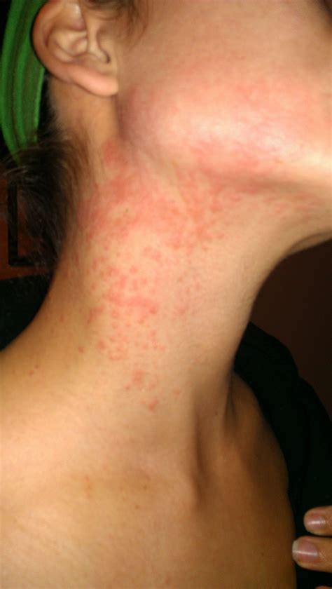 Face And Neck Rash Pictures Photos