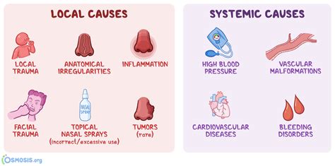 Epistaxis What Is It Types Causes Prevention Treatment And More