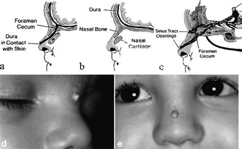 Intracranial Midline Dermoid And Epidermoid Cysts In Children In