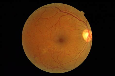 Retina Features Project For Segmentation Of Blood Vessels