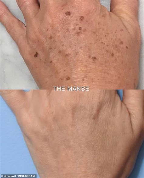 Cosmetic Surgeon Explains Why 690 Freckle Removal Treatments Are So Popular Daily Mail Online