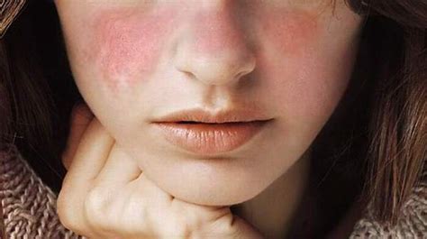 What Is Systemic Lupus Erythematosus Best Online Md