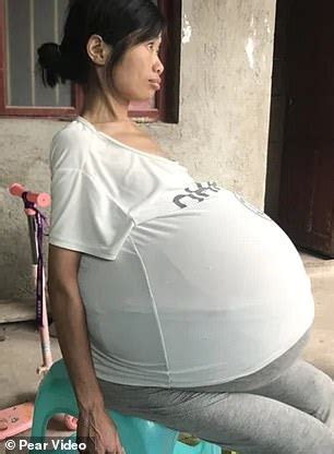 Mysterious Condition Leaves Chinese Womans Belly Growing Uncontrollably