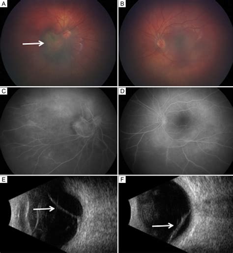 Juvenile X Linked Retinoschisis Presenting As Juxtapapillary Retinal
