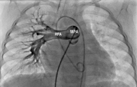 Pulmonary Angiography Showing The Absence Of The Left Pulmonary Artery