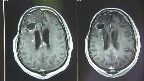 New Device Treats Brain Tumors Without Chemotherapy Radiation Fox News