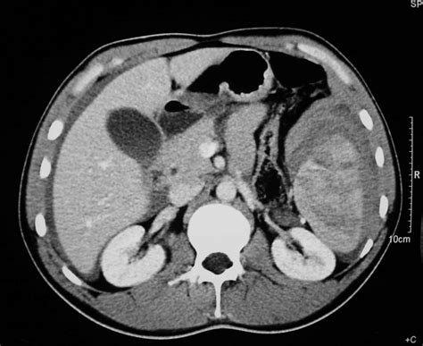 Ct Diagnosis Of Spontaneous Rupture Of Spleen As The Initial