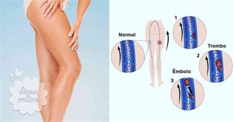 Saiba Como Evitar Uma Trombose Venosa Profunda Conhe A Os Sintomas E