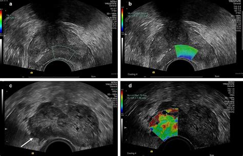 A B Mode And B Swe Us Of Normal Prostate Transrectal Sonogram Shows
