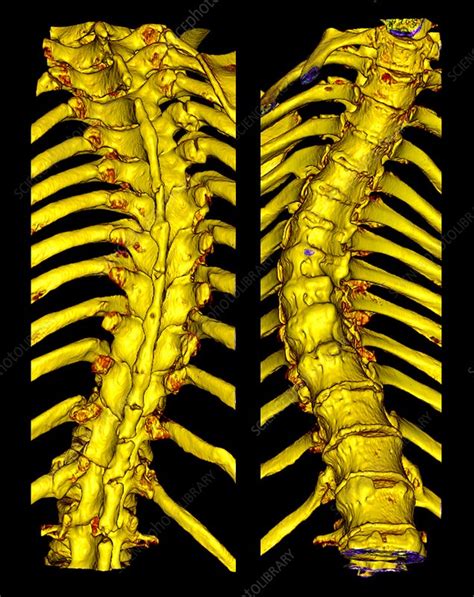 Scoliosis Of The Thoracic Spine 3d Ct Scan Stock Image C0345264