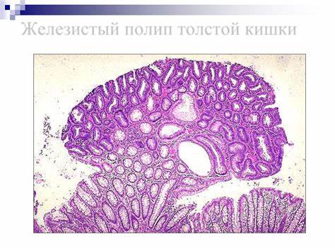 Полип толстой кишки диета Эпителиальные опухоли (лекция по патологической анатомии) Эпителиальные опухоли (лекция по патологической анатомии) Полип толстой кишки диета