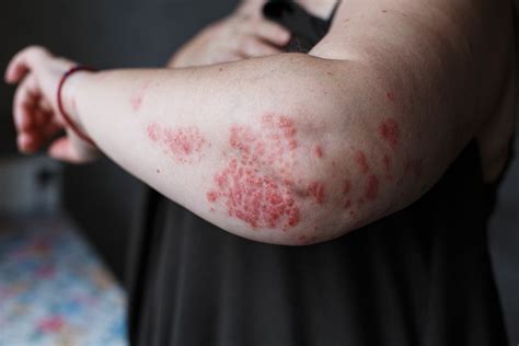 Psoriasis Bumps On Elbows