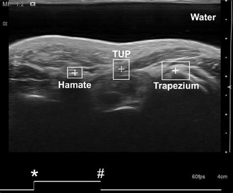 Ultrasound Image Of The Carpal Tunnel Recorded At The Hook Of The