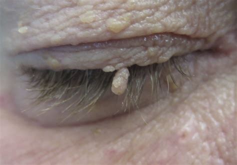 Eyelid Lumps And Bumps Benign Eyelid Lesions Saul Rajak Ophthalmology