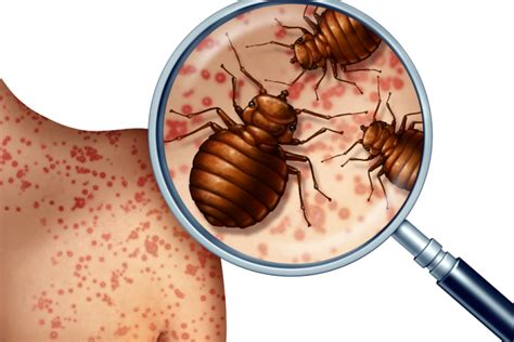 Do I Need To Call An Exterminator How To Identify Bed Bug Bites