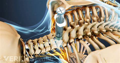 Diagnosing Cervical Osteoarthritis