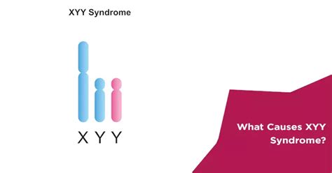 What Are The Causes Of Xyy Syndrome Nova Ivf Fertility