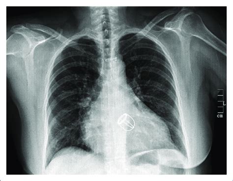 Chest Radiography Showing A Caged Ball Prosthetic Valve In Mitral