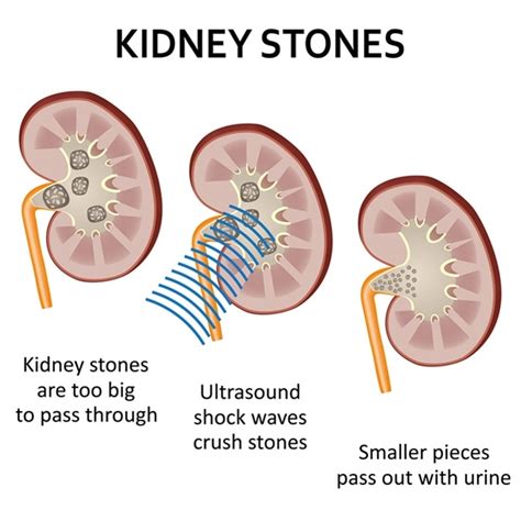 Can Anything Naturally Dissolve Kidney Stones Discover Effective Methods