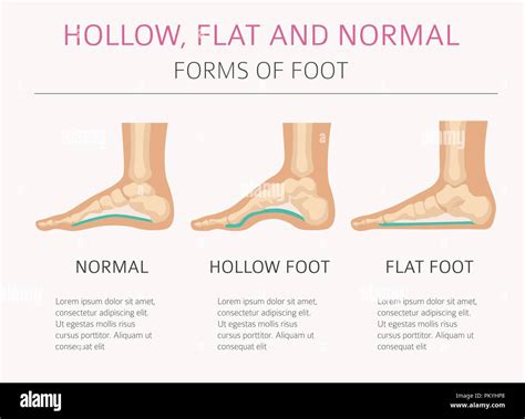 Fuß Verformung Arten medizinische Krankheit Infografik Hohl Flach
