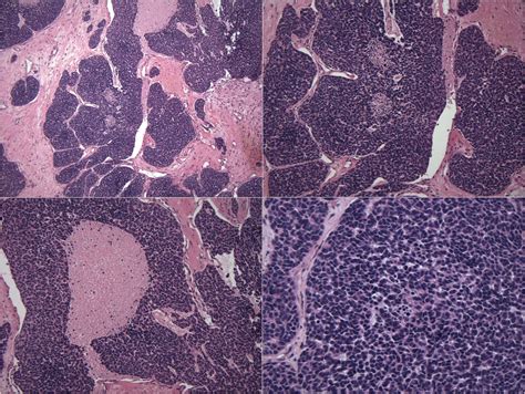 Pathology Outlines Sinonasal Undifferentiated Carcinoma Snuc