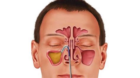 Sinusitis Paranasal Sinuses Symptoms Causes Risk Factors Types
