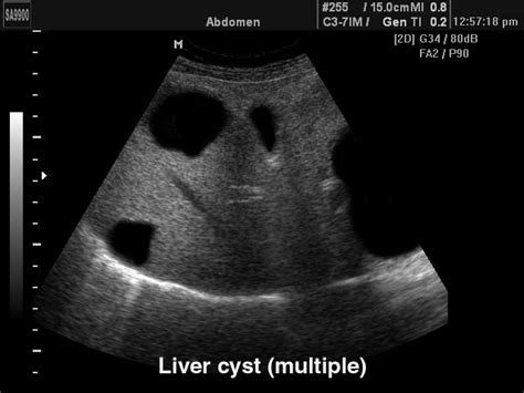 Medisonru Liver Cyst Multiple Sa 9900 152