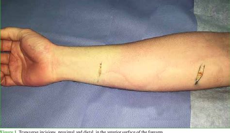 Figure 1 From Chronic Exertional Compartment Syndrome Of The Forearm