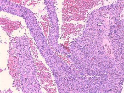 Primary Soft Tissue Giant Cell Tumor A Rare Case Exhibiting Features