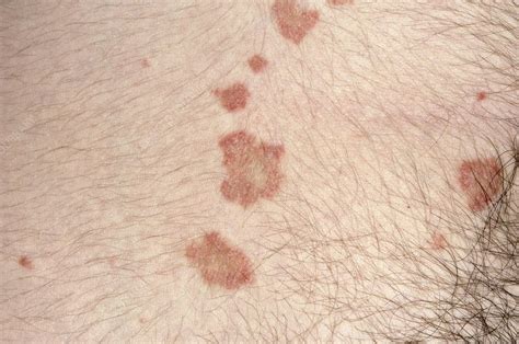 Acute Guttate Psoriasis Stock Image M2400772 Science Photo Library