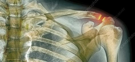 Fractured Collar Bone X Ray Stock Image C0540305 Science Photo