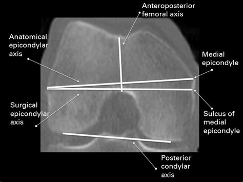 The Correct Rotation Of The Femoral Component In Patellofemoral