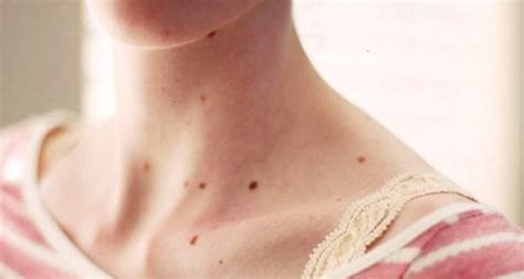 What Causes Tiny Red Spots On Skin And How To Know Whether They Are
